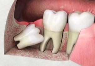 Wisdom Tooth Surgery