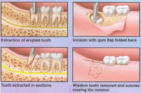 procedure of wisdom tooth surgery