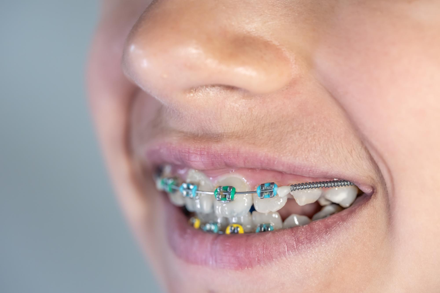 Braces With Missing Teeth
