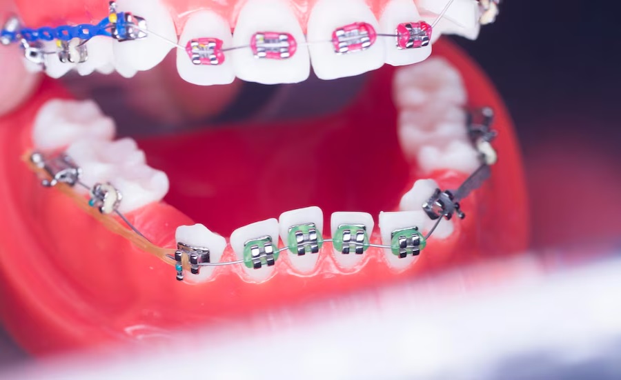 Dental Braces Adjustment Time