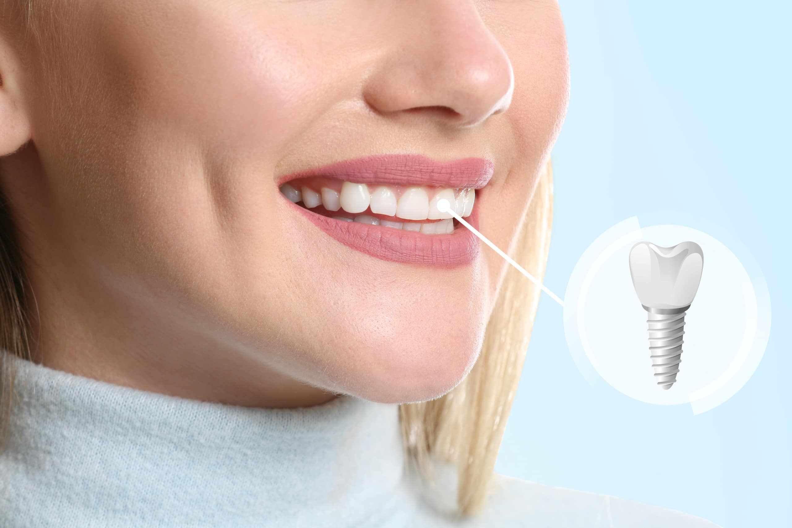 dental implant cost Singapore - Garden Dental