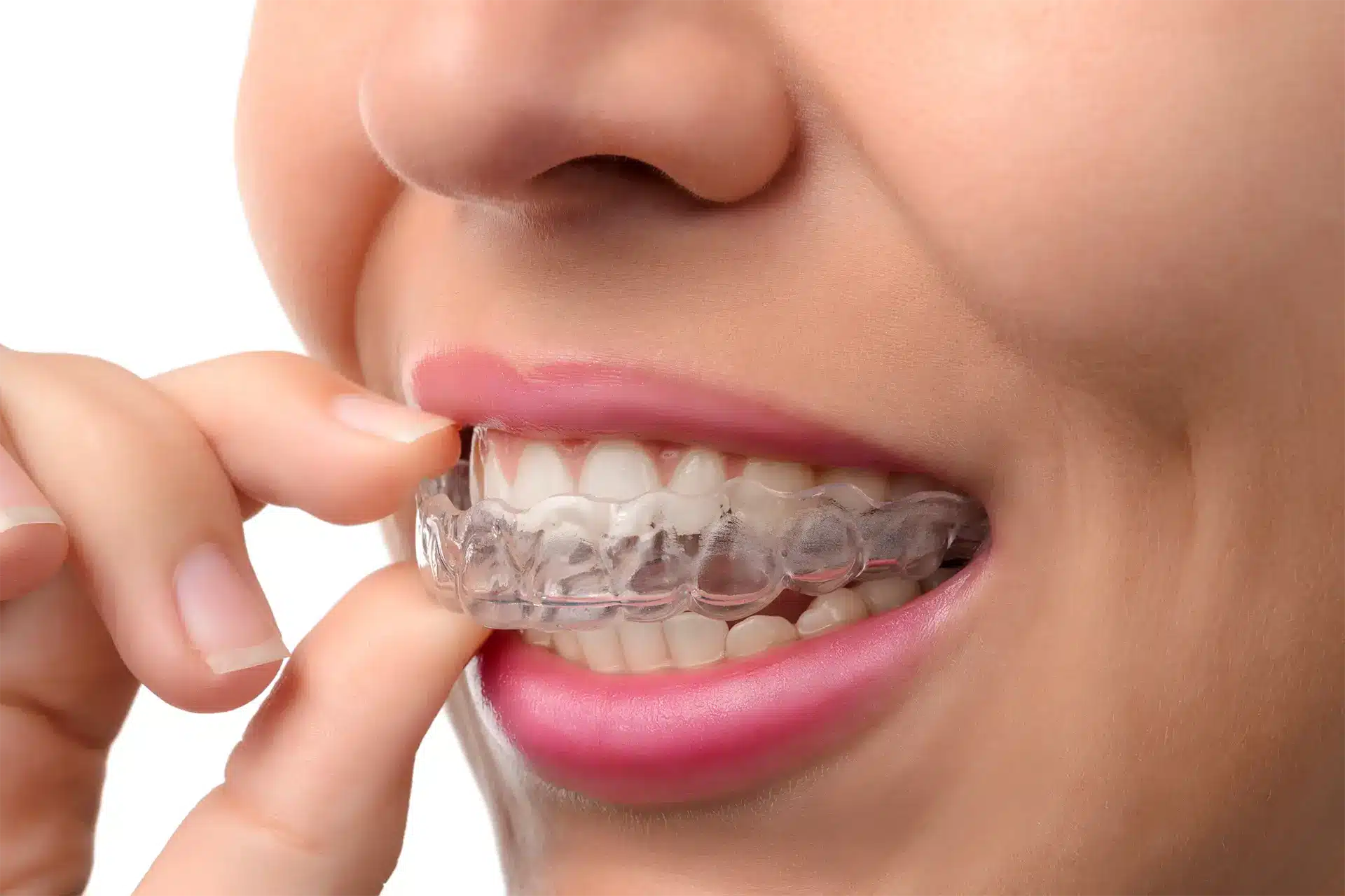 Woman wearing Invisalign tray to correct alignment issues.
