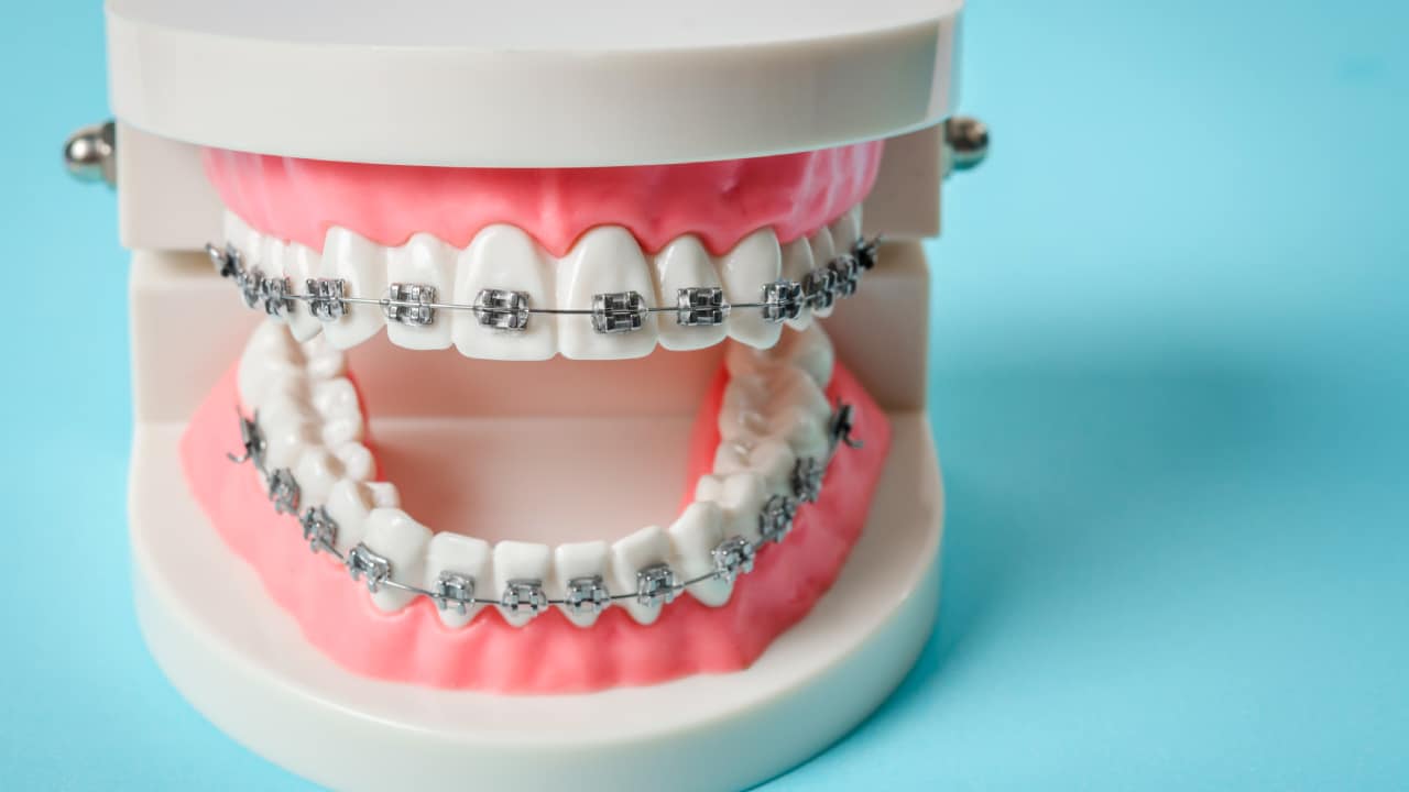 Why dental brace prices vary