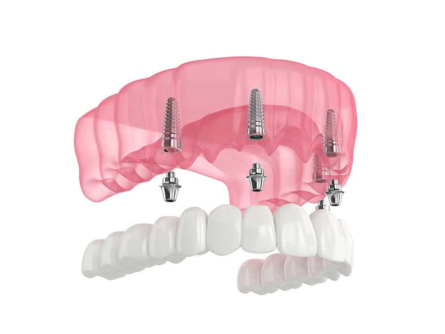 What are dental implants