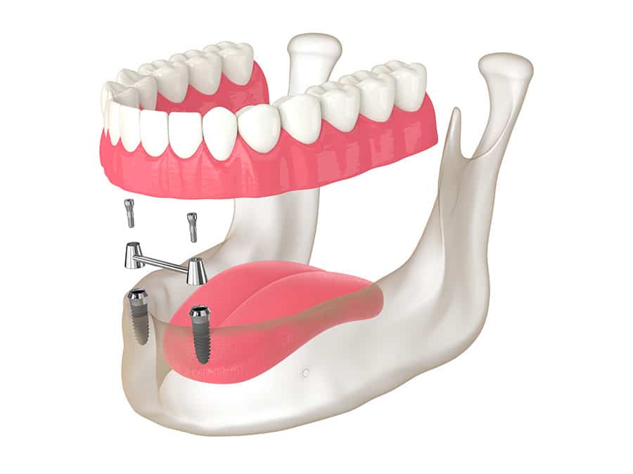 Implant-Retained-Overdenture-1 Implant-Retained Overdenture