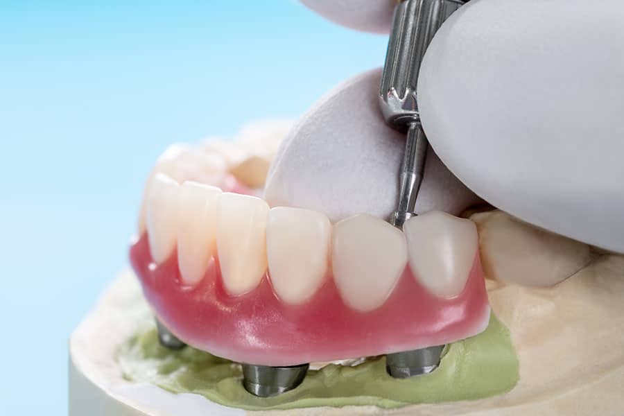 Implant-Retained-Overdenture-3 Implant-Retained Overdenture