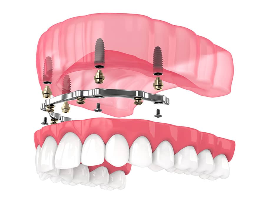 Implant-Retained-Overdenture Implant-Retained Overdenture